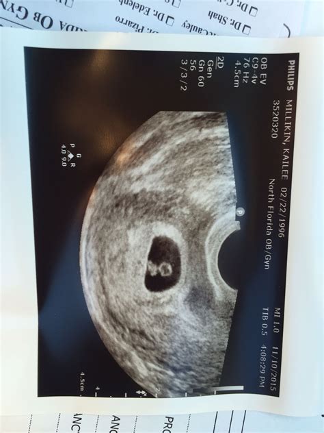 6 weeks 1 day ultrasound hiccups pregnancy