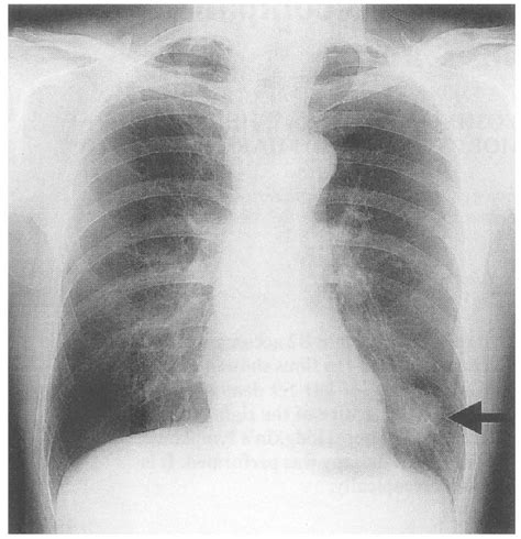 Figure Chest X Ray Film On Admission Showing A Mass Shadow In The Left