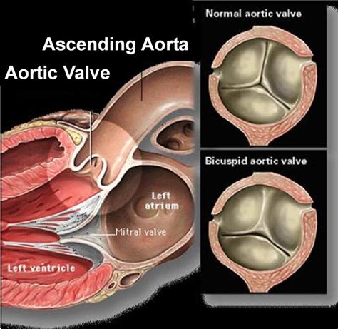 Heart valve replacement and sex