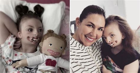 girl with facial deformities and rare brain disorder passed away aged