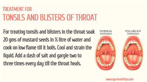 throat ulcer symptoms adult videos