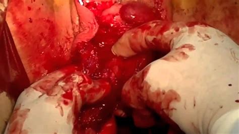 Total Prolapse Of Uterus Vaginal Hysterectomy Youtube