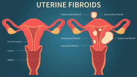 the link between uterine fibroids and heavy menstrual bleeding