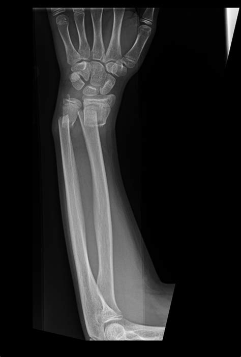 broken arm buyxraysonline