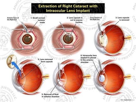 Extraction Of Right Cataract With Intraocular Lens Implant