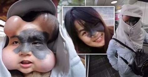 Woman With Cancerous Facial Mole Has Four Balloons