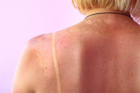age spots  skin cancer      lifestyle