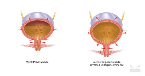 7 Exercises To Restore A Weak Pelvic Floor Pelvic Floor