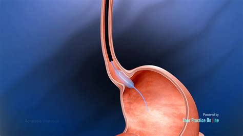 achalasia dilation video medical video library