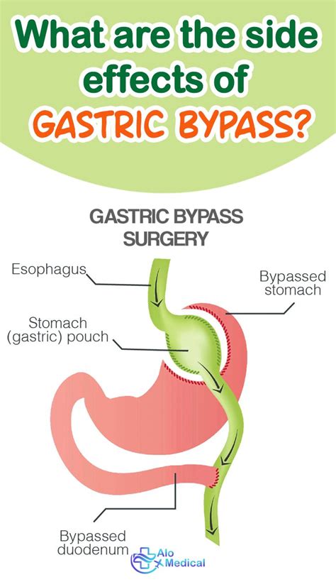 What Are The Side Effects Of Gastric Bypass Gastric