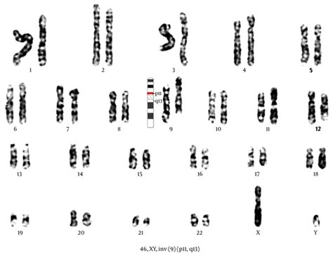 Karyotype Of The Cmpd Patient Showing 46 Xy Inv 9 P11 Q13 Download