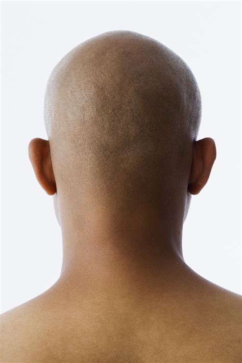 early balding  raise risk  als study finds huffpost