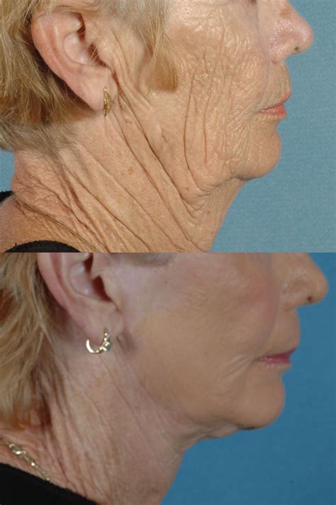 kybella injectable non surgical double chin removal il