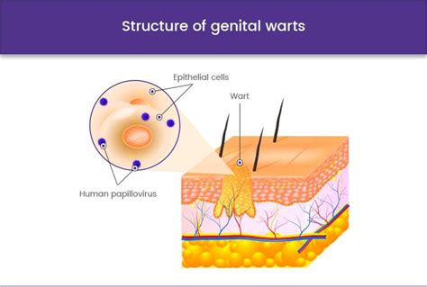 ᐅ buy genital warts treatment and information online