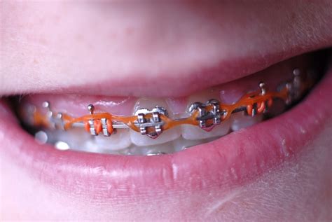 elastics  braces orthodontic