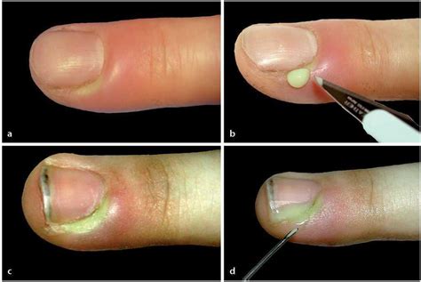 Infecciones Del Surco Ungueal De Los Dedos Tratamiento De La
