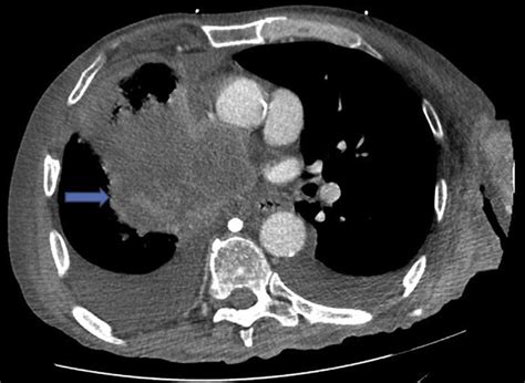 Ct Scan Of The Chest Axial View Showing The Necrotic Right Hilar Mass