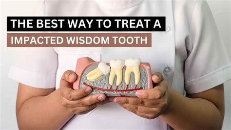 treat  impacted wisdom tooth
