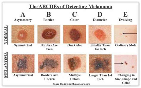 Spotting A Melanoma Early… Hoppers Lane General Practice