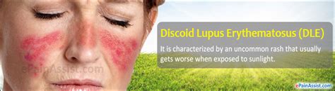 Discoid Lupus Erythematosus Dle Causes Symptoms Treatment