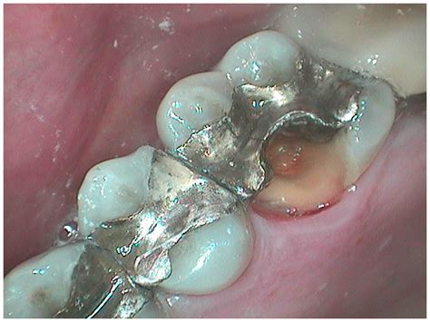 fix  broken tooth   day dr joe nt nguyen dds