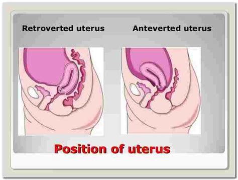 Anteverted Uterus And Getting Pregnant 652x493