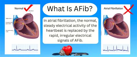 What Is Atrial Fibrillation Afib Or Af Symptoms Treatments