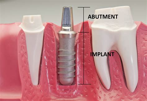 missing teeth treatment  plano tx dental implants  allen tx