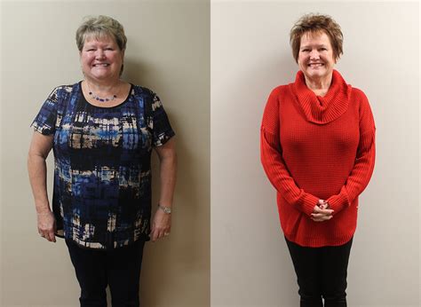 Carol S Weight Loss Before And After St Louis Bariatrics