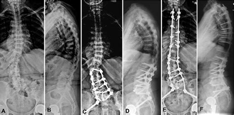 Surgical Outcomes Of Long Spinal Fusions For Scoliosis In