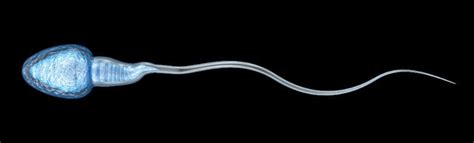 Where Does Sperm Go After Vasectomy Pollock Clinics