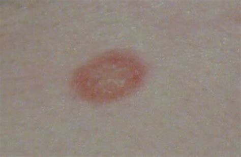 tips  identifying common skin rashes