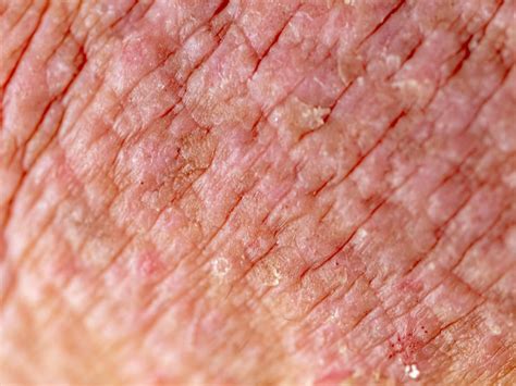 eczema atopic dermatitis symptoms  treatment
