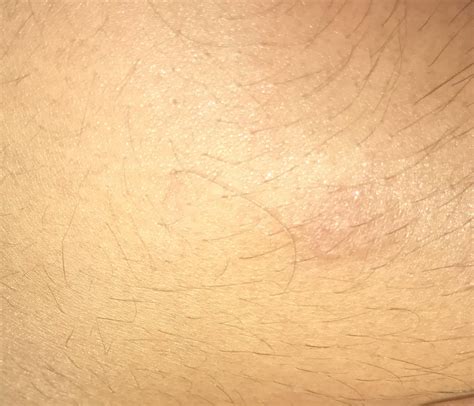 weird small skin patch  chest  noticed   skin patch  im