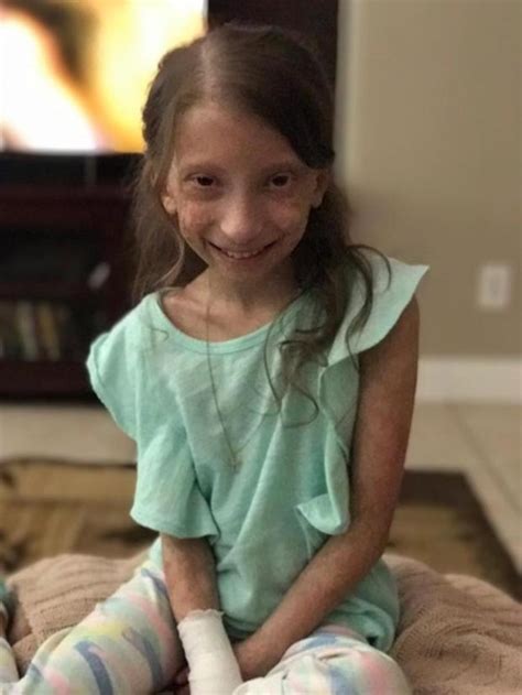 after living with a rare disorder ‘spicy menifee girl now battling