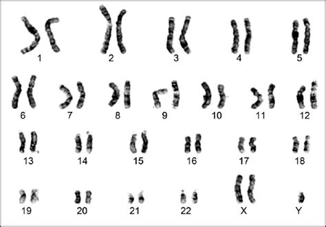 File Karyotype Of A Klinefelters Syndrome Patient  Embryology