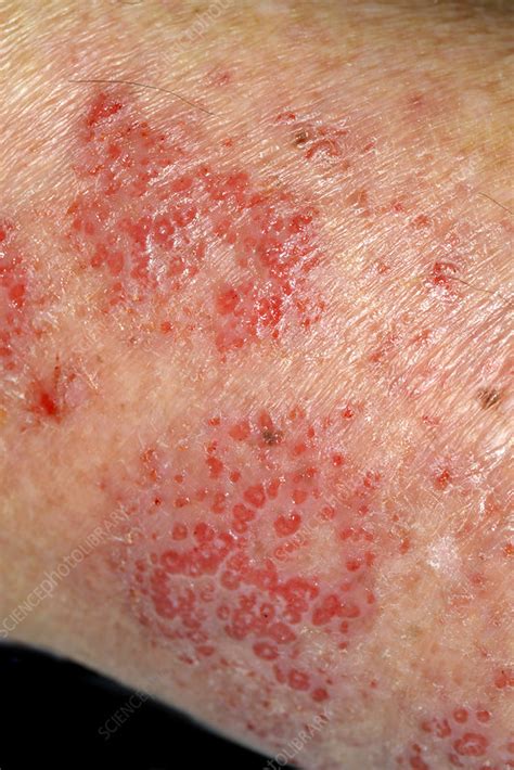 dermatitis stock image  science photo library