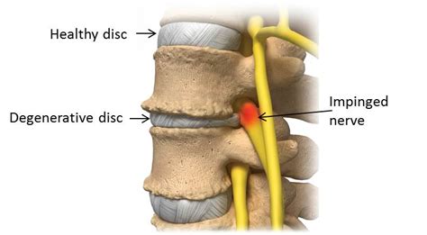 degenerative disc disease spine surgery san antonio seguin new braunfels