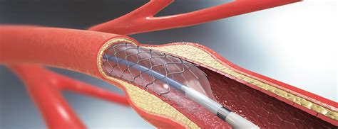 angioplasty  stent placement   heart johns hopkins medicine
