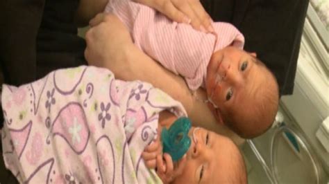 iowa woman has rare twins — and didn t know she was pregnant