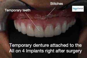 clean    dental implants dental news network