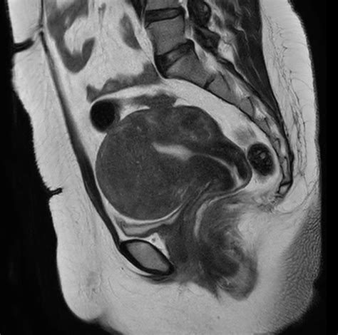 female pelvis with myoma compressed sense philips mr body map