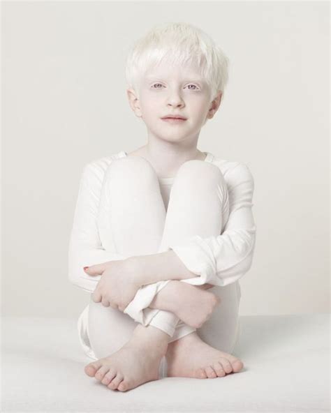 pin  manderqen  albino albinism face photography people