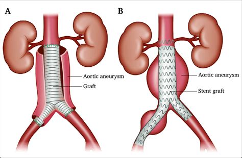 open surgery   abdominal aortic aneurysm open aaa repair