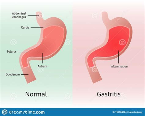 gastritis  inflammation irritation  erosion   lining   stomach medical vector