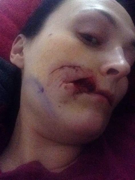 graphic content pretty mum left with chunk missing from face after drunken attack daily star