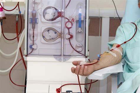 hidden hypercalcemia common in hemodialysis patients renal and urology news