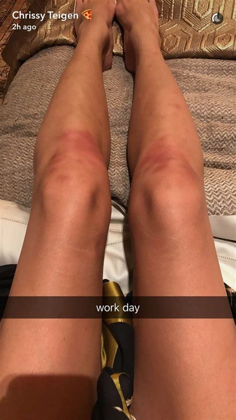 Chrissy Teigen Snapchats Pics Of Her Painfully Bruised