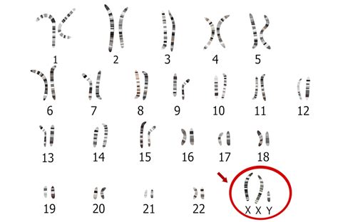 Klinefelter Syndrome Causes Karyotype Diagnosis Treatment Porn Sex