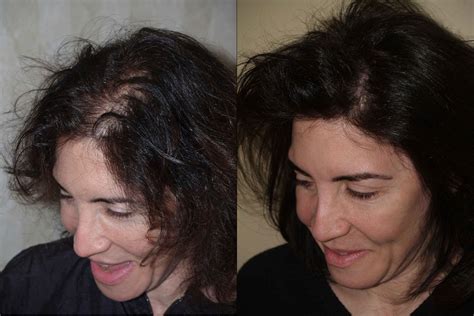 Patient 58205 Foundation For Hair Restoration